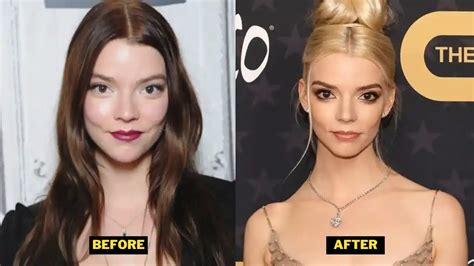 Anya Taylor-Joy Plastic Surgery 2023. Before-After Pictures Of Princess Peach Actress.