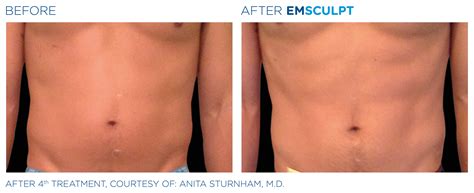 Body Sculpting Treatment: What To Do Before and After A Procedure - NewRadianceEMSCULPT.com