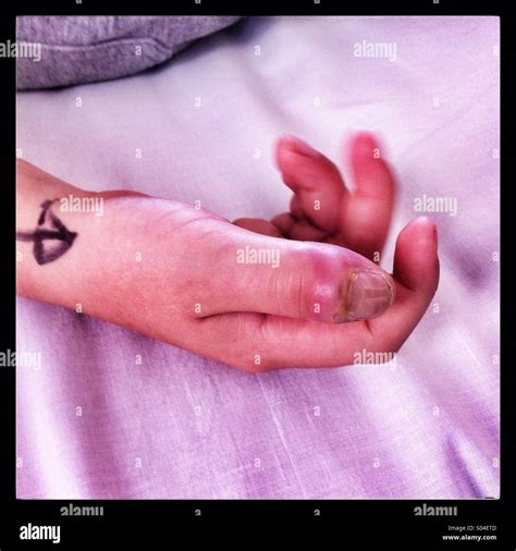 Boys swollen infected thumb Stock Photo - Alamy