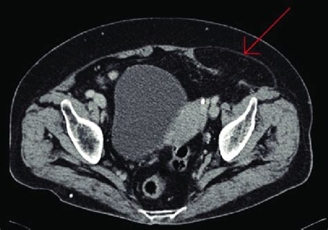 Imagen de tomografía abdominal que muestra una hernia de Spiegel... | Download Scientific Diagram