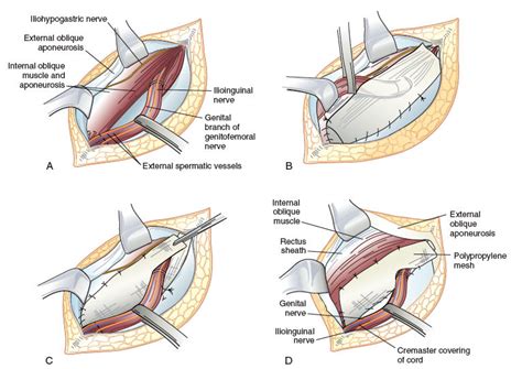 SurgicalCORE | Table/Figure