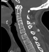 Cases | System: Spine | Radiopaedia.org