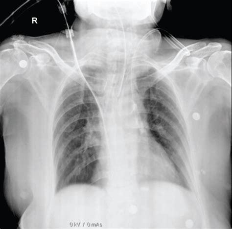 Showing temporary transvenous pacing.