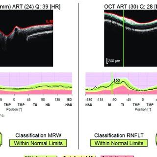 SD-OCT of the right eye of a patient showing normal RNFL values in all... | Download Scientific ...