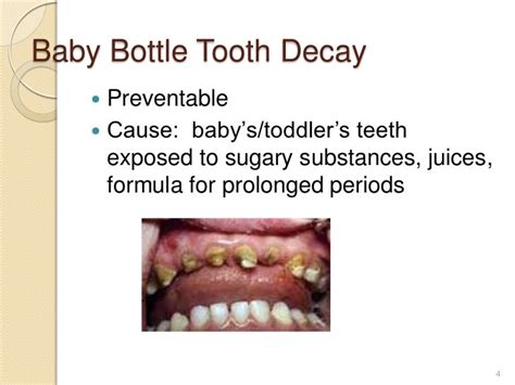 Baby bottle tooth decay