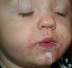 How to treat baby teething rash | Intelligent Dental