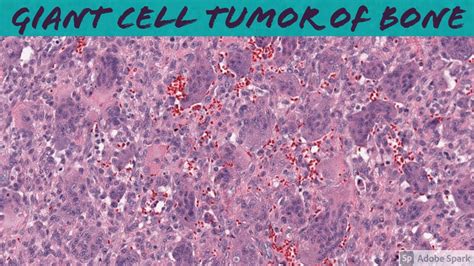 Giant Cell Tumor Histology