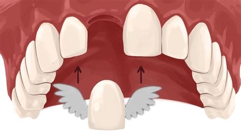 Resin Retained Bridges Simplified in 10 Short Minutes! | Ace Courses Webinar Summary - YouTube