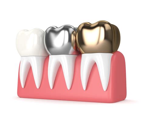 Stainless Steel Crowns Compared to Other Crowns