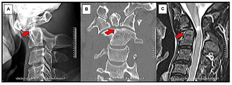 Atlantoaxial Instability