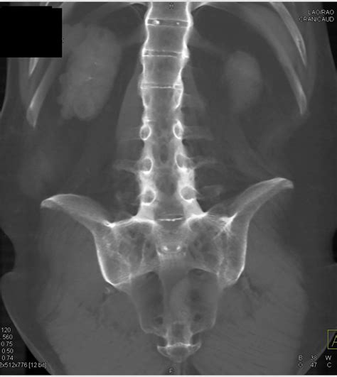 Ankylosing Spondylitis with Sacroiliac Joint (SI Joint) Fusion - Musculoskeletal Case Studies ...