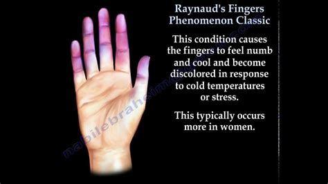 Raynaud s fingers phenomenon classic everything you need to know dr nabil ebraheim – Artofit