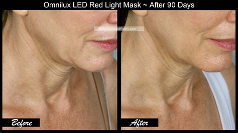 OmniLux LED Mask ~ 3 Month Results! Before & After Face, Neck, & Hand ...