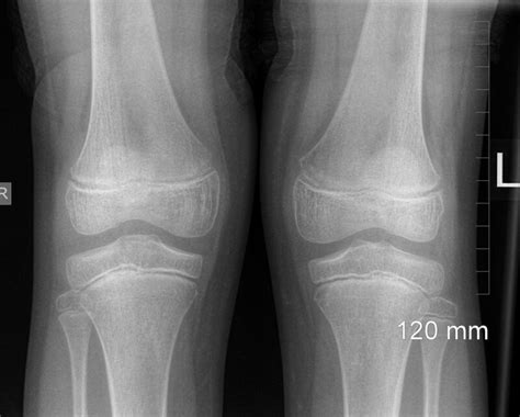 Knee X-ray: What It Shows, Interpretation Of The X-ray - 2024 Guide ...