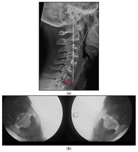 JCM | Free Full-Text | Non-Surgical Management of Upper Cervical Instability via Improved ...