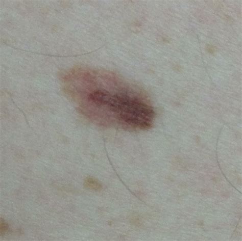 Early Stage Melanoma Symptoms - Doctor Heck