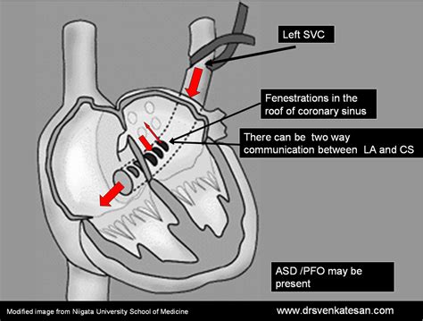 unroofed coronary sinus | Dr.S.Venkatesan MD