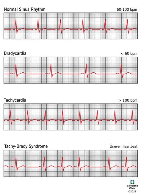 Sick Sinus Syndrome: Symptoms, Causes and Treatment.