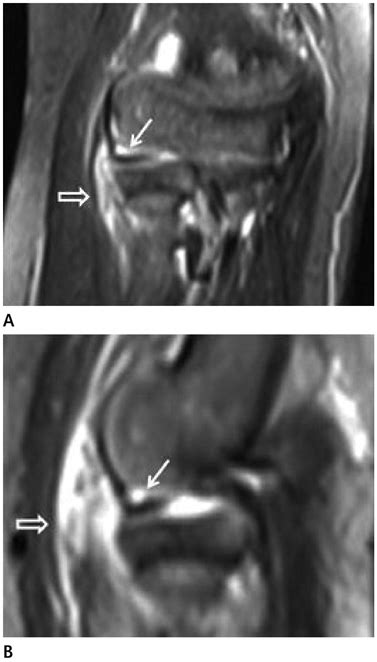 MRI of Spontaneous Reduction of an Entrapped Annular Ligament in an Atypical Pulled Elbow ...