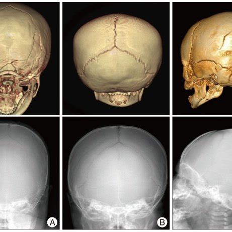 Skull Fracture Types