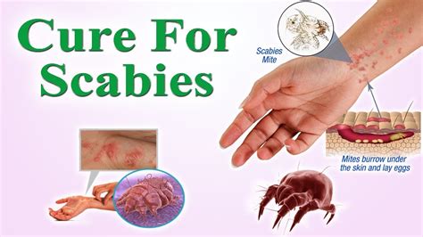 Scabies Causes Symptoms Pictures Of Rash And Treatment Everyday ...