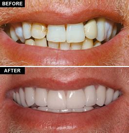 Composite Veneers VS Porcelain Veneers - Center for Restorative & Cosmetic Dentistry