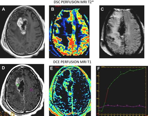 Magnetic Resonance Perfusion and Permeability Imaging in Brain Tumors ...