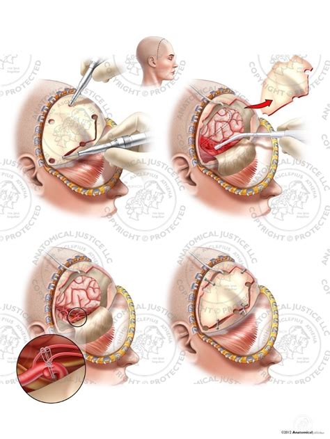 Right Craniotomy with Aneurysm Clipping and Ventriculostomy - No Text