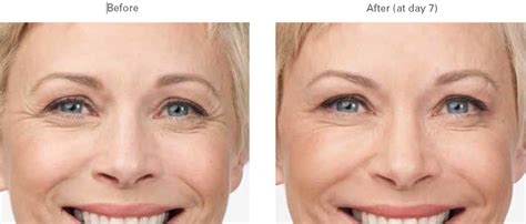 Botox | Remove Wrinkles | Crows Feet, Between Eyes, Forehead, | Medical Spa | Boise Meridian ID ...