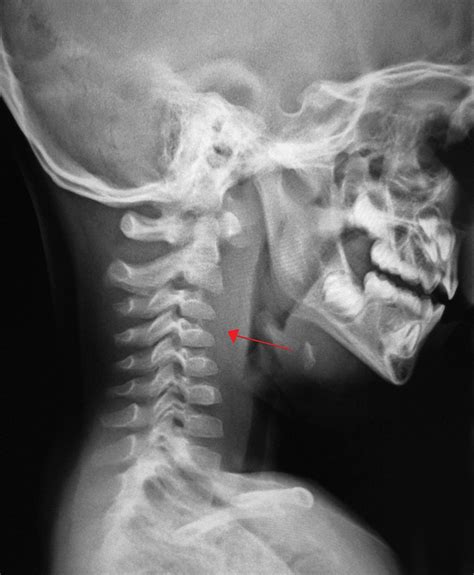 Retropharyngeal Abscess: Causes, Symptoms, and Treatment