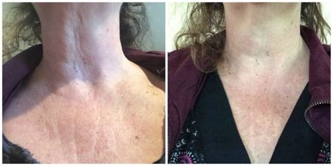 Crepe Erase Review - Results on Day 21 on a 50-Year-Old Woman