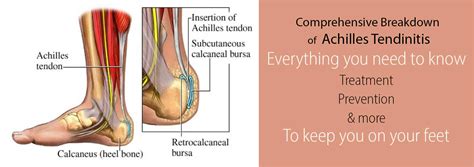 Achilles Tendonitis - The Complete Guide to Causes & Treatments