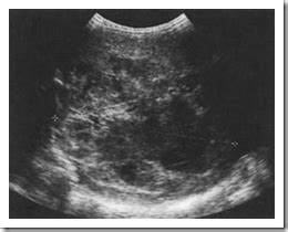 Ultrasound images of Hepatoblastoma and hepatocellular carcinoma (HCC) pediatric abdomen ...