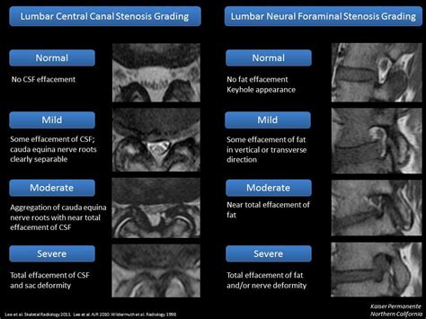 Lumbar Spine Stenosis Grading