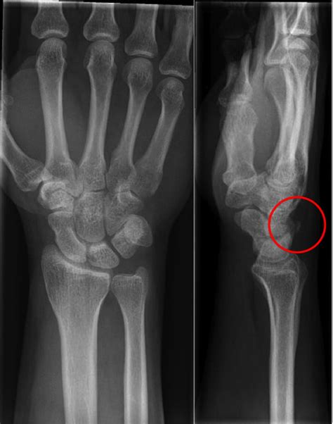 Simultaneous bilateral triquetral fractures, acquired in two separate accidents within 9 h | BMJ ...