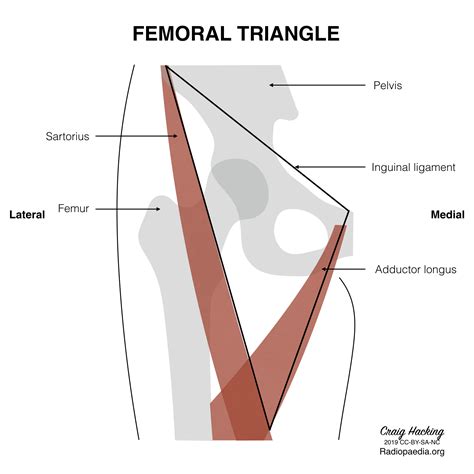 Radiopaedia - Drawing Boundaries of the femoral triangle - English ...