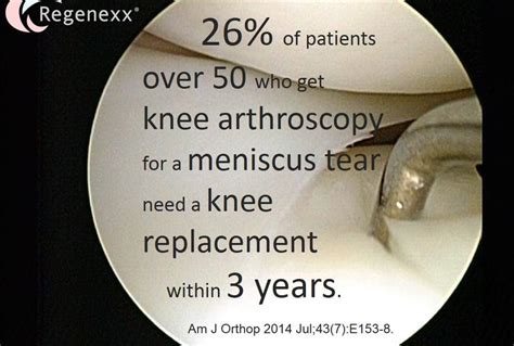 Knee Arthroscopy Alternatives? 1 in 4 Patients End up with a Rapid Knee Replacement! - Wasatch ...