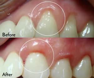 Connective Tissue Graft - Toronto Dentist Dr. Yolonda Cruz