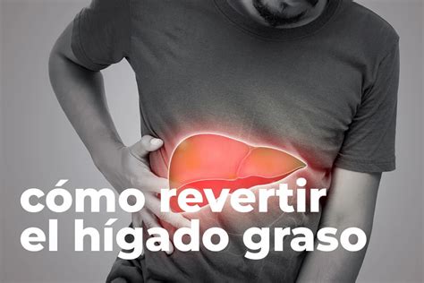 ¿Cómo revertir el Hígado Graso? Causas, Tratamiento y Dieta.