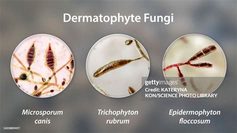 Dermatophyte Fungi Illustration High-Res Vector Graphic - Getty Images