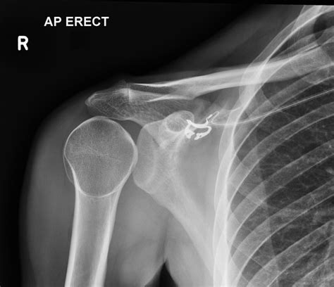 Posterior Shoulder Dislocation | Reflex Health