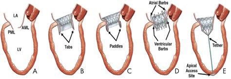 Transcatheter Mitral Valve Repair and Replacement: Current Evidence for ...