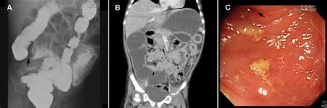 Apple-core lesion of the terminal ileum in a child with chronic ...