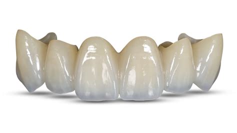 Best Dental Crown and Bridge Dental Lab - Glidewell Dental