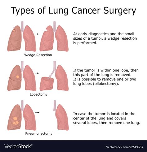 Lung Cancer Surgery - MEDICINE FOR WORLD