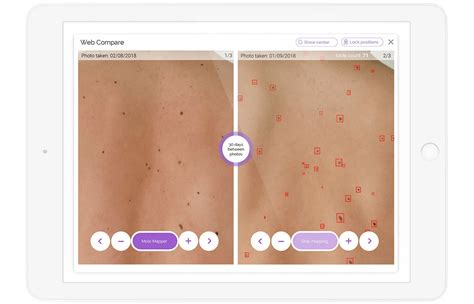 Mole Mapping Guide | Getting a Mole Map & What You Should Know