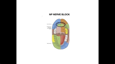 Nasopalatine Nerve Block Injection - YouTube