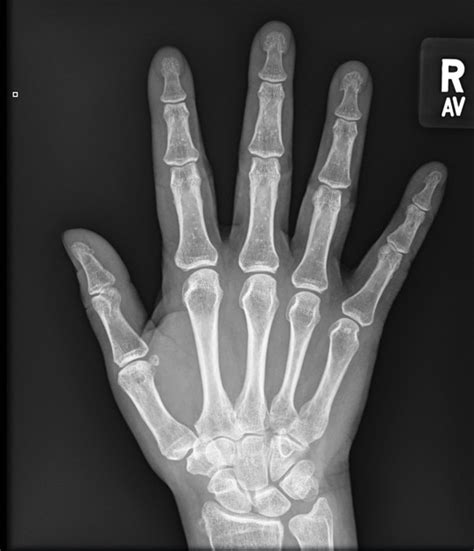 Hand Xray