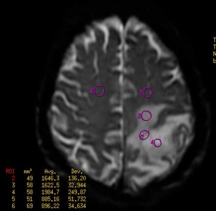 Gliosarcoma | Image | Radiopaedia.org