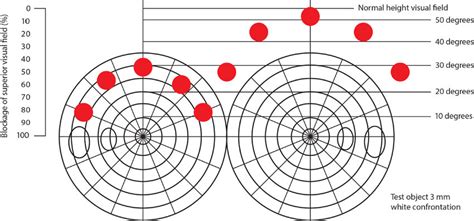 Example of a visual field test performed in the office with a Q-tip not... | Download Scientific ...